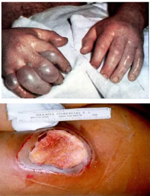 Gambar 10. Kerusakan pada kulit akibat paparan radiasi gamma berupa blister   (kanan) dan ulceration (kiri)