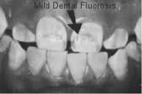 Gambar 1. Mild dental fluorosis 