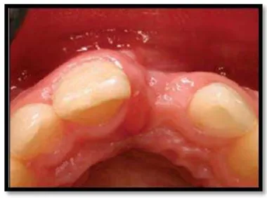Gambar   5:      Penurunan    tinggi     linggir                 Gambar 6 :  Dinding bukal soket gigi insisivus alveolar    setelah   ekstraksi   dari   kaninus                 centralis  kiri  atas  “kolaps”  dua  bulan pasca   ekstraksi