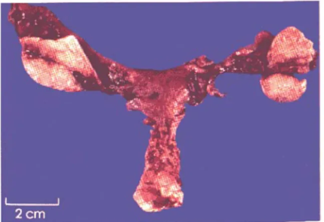 Gambar 1. Gonadoblastoma bilateral. Masing- Masing-masing gonad dibelah dua untuk menunjukkan  massa tumor kecil disertai dengan bintik-bintik  yang menunjukkan fokus-fokus pengapuran