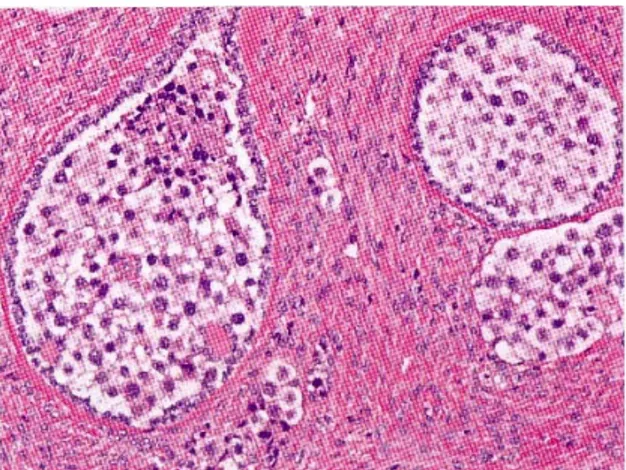 Gambar 3.  Gonadoblastoma. Sarang-sarang  tumor terdiri dari sel-sel germinal besar dengan  sitoplasma terang dan sel-sel jenis sex-cord  yang  lebih kecil mengelilingi sel-sel germinal  dan deposit-deposit eosinofilik bahan membran  basalis  disertai kals