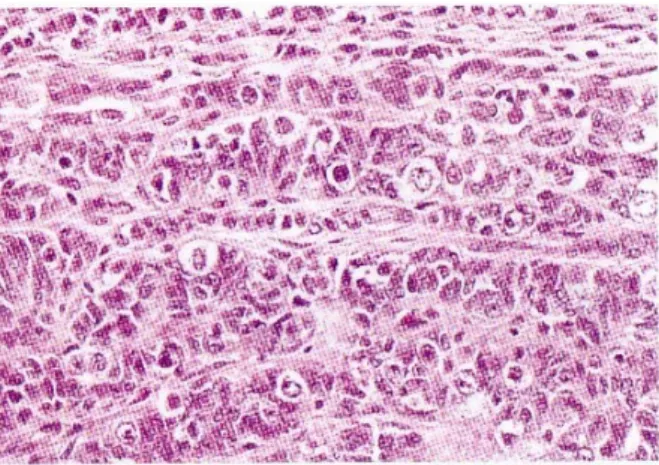 Gambar 4.  Mixed germ cell-sex-cord-stromal  tumor. Sarang-sarang tumor terdiri dari sel-sel  germinal dengan inti bulat besar (beberapa  dengan nukleoli prominen) yang bercampur  dengan sel-sel jenis sex-cord  berbentuk  oval  sampai  kumparan