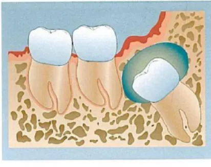 Gambar 3 kista dentigerous 