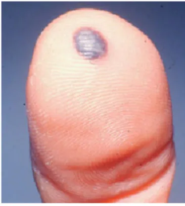 Gambar 11. Hematoma 