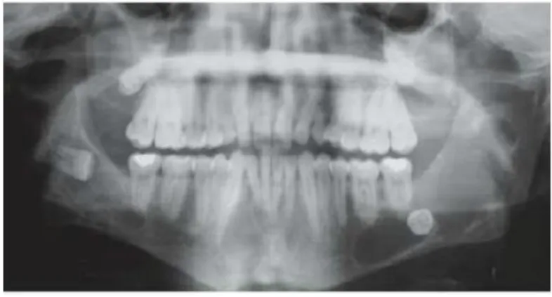 Gambar  7  gambaran  panoramik  dari  Keratocystic  Odontogenik  Tumor  laki-laki  usia  18  tahun,  tumor mengenai mandibular  bilateral  dan maksila dengan NBCCS  