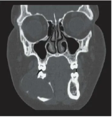 Gambar  10  gambaran  CT  scan  dari  pasien  yang  sama  terlihat  adanya  perluasan  tulang kortikal  bukal dan lingual  pada mandibula  kanan