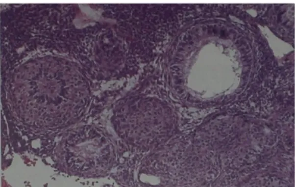 Gambar  16  Gambaran  histopatologi adenomatoid odontogenik tumor 