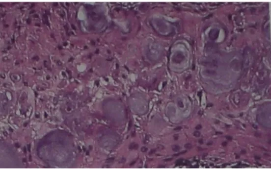 Gambar  18.  Gambaran  histopatologi calcifying epithelial  odontogenik tumor 