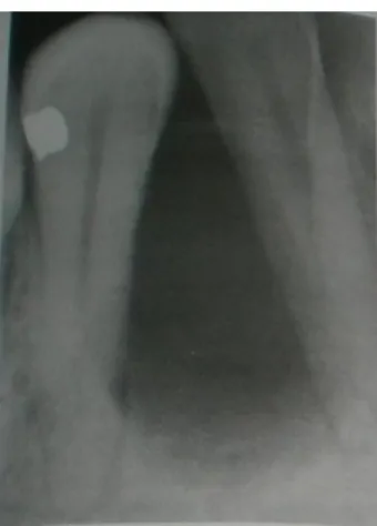 Gambar  19.  Gambaran  radiografi  odontogenik myxoma 