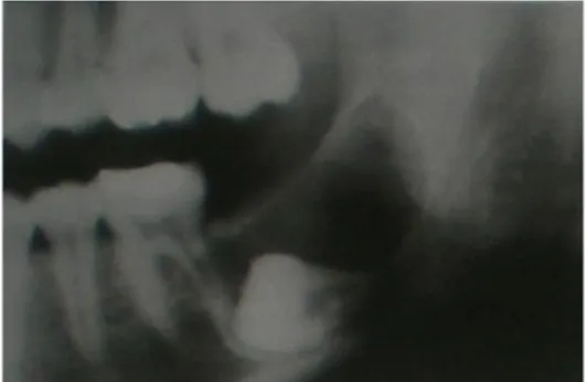 Gambar  21.  Gambaran  radiografi  Ameloblastik  fibroma 