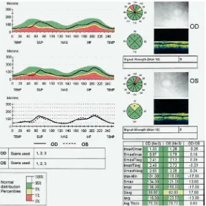 Gambar 4. Hasil Cetakan Fast Retinal Nerve Fiber Layer (RNFL) dengan Meggunakan Stratus OCT 