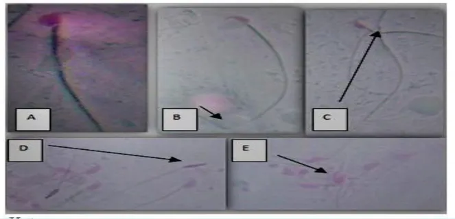 Gambar 4. Abnormalitas Spermatozoa pada Duktus Deferen. 