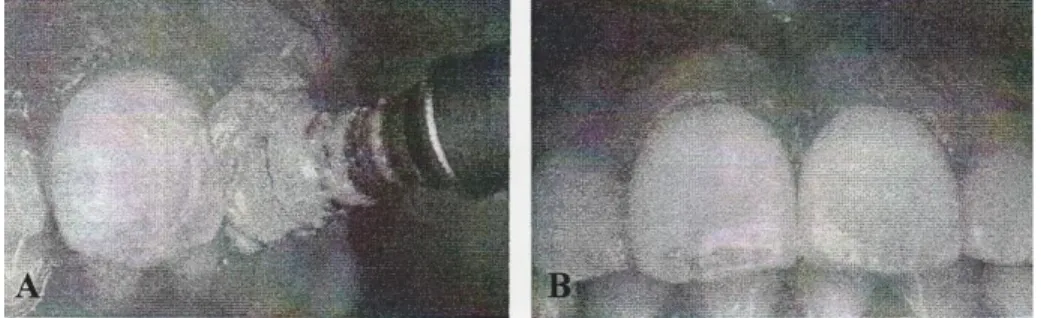 Gambar  6.  A.  Pemolesan  menggunakan  pasta  profilaksis,  B.  Hasil  akhir  setelah  Perawatan  (Sumber :  Micro abrasion dentistry teknology [online] 2005 [cited 2005]
