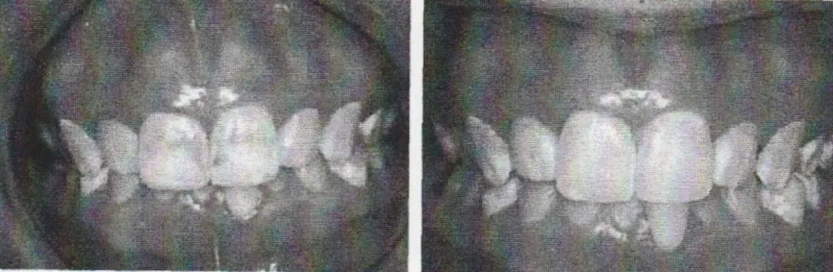 Gambar 3. A. Gigi 11 dan 12 yang mengalami fluorosis dental jenis sedang sebelum perawatan,  B