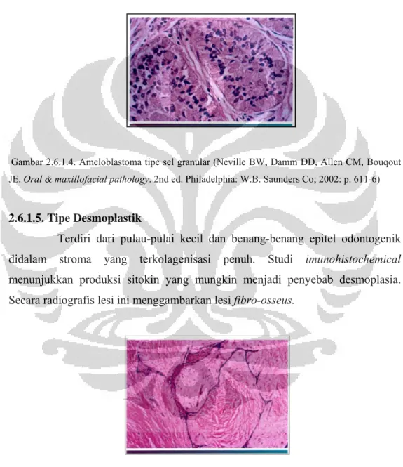 Gambar 2.6.1.5.Ameloblastoma tipe desmoplastik  (Neville BW, Damm DD, Allen CM, Bouqout  JE