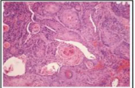 Gambar 4. Gambaran histopatologi karsinoma sel skuamosa pada KAE 2 Pemeriksaan  histopatologi  akan  menunjukkan  sel-sel  epidermal  yang  berbentuk  spindel  pleomorfik  proliferatif  dengan  bulatan-bulatan  keratin  dan  jembatan interseluler yang menj