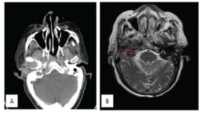 Gambar 5. CT scan (A) dan MRI (B) pada pasien karsinoma sel   skuamosa KAE telinga kanan