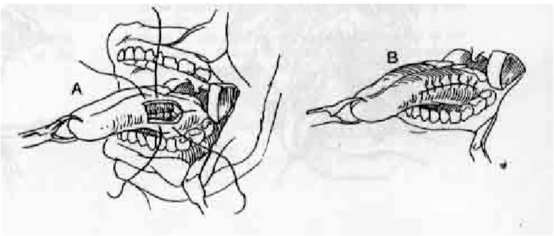 Gambar 9. Post hemiglosectomy  Teknik Operasi Selective Neck Dissection 