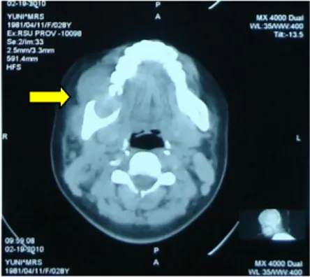Gambar  1.  CT  scan  kepala  potongan  axial  tanpa  kontras diperoleh kesan massa medula dengan slight  bone  expansion  corpus  mandibula  dekstra  suspek  malignansi (panah)