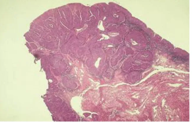 Gambar 2.5. Karsinoma basaloid. Berupa neoplasma yang solid yang  terdiri dari sarang-sarang dengan epitel yang proliferatif