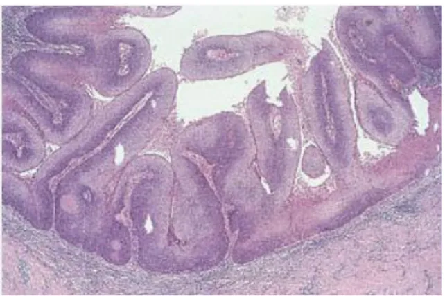 Gambar 2.6. Warty (condylomatous) carcinoma. Tampak papila tipe  kondilomatosa arboriformis, dengan inti fibrovaskular sentral