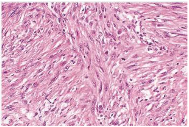 Gambar 2.9. Karsinoma sarkomatoid.Neoplasma sel spindel yang  menyerupai sarkoma pada karsinoma sarkomatoid