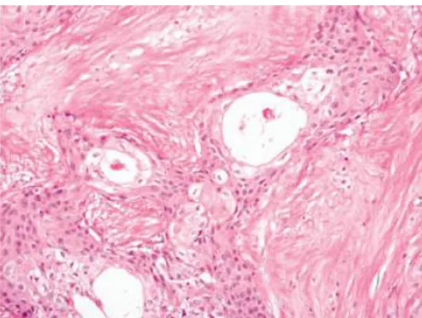 Gambar 2.11. Karsinoma adenoskuamosa. Tampak kelenjar-kelenjar yang  telah diinfiltrasi oleh sel-sel tumor
