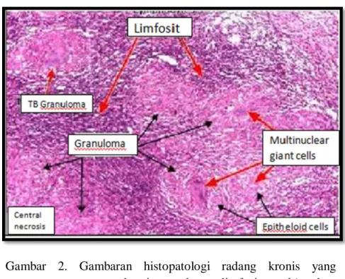 Gambar 2. Gambaran histopatologi radang kronis yang  mengandungi granuloma, limfosit, multinuclear  giant cells dan epitheloid cells