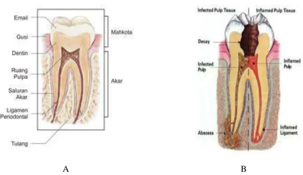 Gambar 2.1. A.  Gambar struktur gigi normal. B. Gambar struktur gigi inflamasi pulpa  (sumber: http://www.com)  