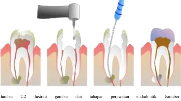 Gambar  2.2  ilustrasi  gambar  dari  tahapan  perawatan  endodontik.  (sumber: 
