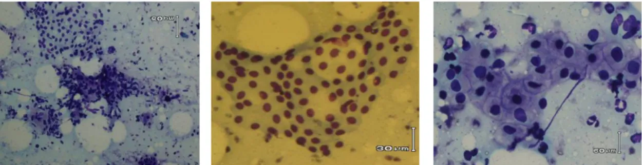 Gambar 3. Gambar mikroskopik sel-sel hati normal; sel-sel berbentuk poligonal dengan sitoplasma  luas, umumnya membentuk cohesive sheets 