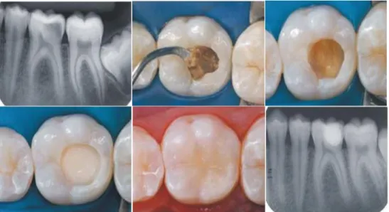 Gambar 1A Secara radiografi terlihat karies dan struktur periapikal normal, B akses kavitas  diikuti  pembuangan  awal  dari  jaringan  dentin  karies  lunak  dengan  ekskavator,  C  setelah  6  minggu, dentin terlihat gelap  dan  kering,  D  RMGI digunaka