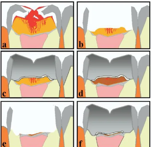 Gambar  2  Diagram  yang  menunjukkan  invasif  yang  minimal  pada  prosedur  stepwise  excavation