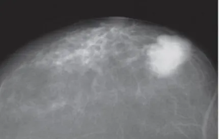 Gambar 6. Pada tipe sklerotik, mamogram  memperlihatkan massa asimetri sentral dengan  penyimpangan struktural (architectural distortion) dan retraksi puting susu dan retaksi  kutaneus sekunder