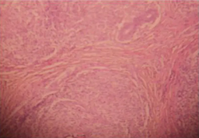 Gambar 9B. Mikro fotografi menunjukkan granuloma dengan Langhans giant cells (high  power)