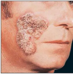 Gambar 190-11. Blastomikosis. Plak yang   Gambar 190-12. Blastomikosis  mengalami peradangan dengan ulserasi   Plak verukosa kronik pada pipi