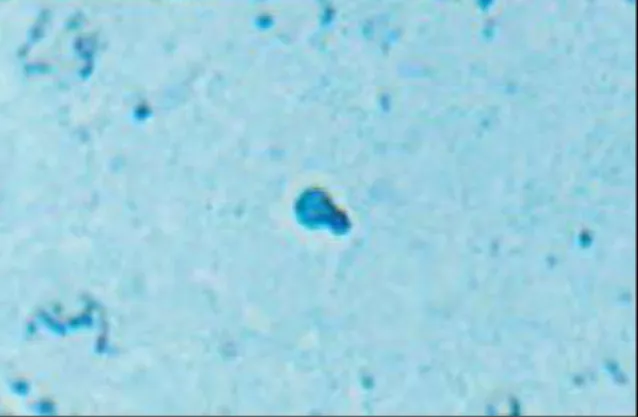 Gambar  190-14.  Blastomikosis.  Spesimen  biopsi  dari  lesi  menunjukkan  bentukan  budding yeast (pewarnaan dengan Gomori Methenamine Silver)