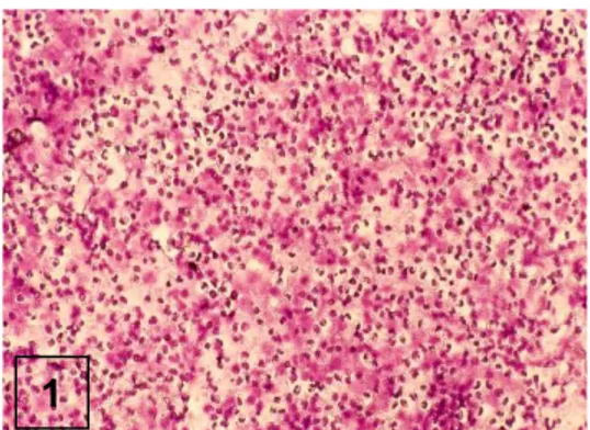 Gambar  1.  Abses  dengan  massa  nekrotik  dan  sel  radang PMN tanpa dark speks (MGG, x400)