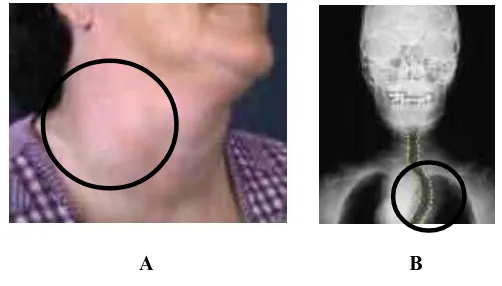 Gambar 5.  A. Penampilan khas gondok dalam seorang wanita berusia menengah. Leher bengkak karena tiroid membesar