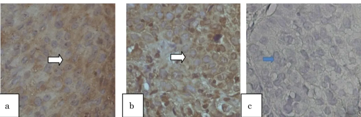 Gambar 1. Ekspresi mTOR berwarna coklat pada sitoplasma sel, (a,b), dan kontrol negatif dengan  pewarnaan Hematoksilin (c) (perbesaran 10 x 40)