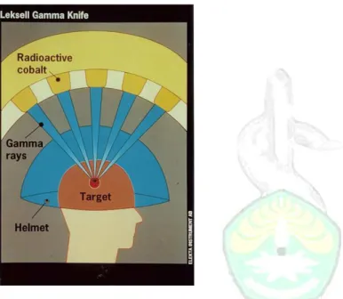 Gambar 3. mesin gamma mengandung 201 sinar cobalt-60 yang menargetkan  radiasi gamma pada bagian otak pasien