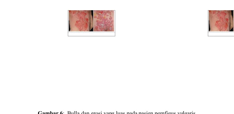 Gambar 6:  Bulla dan erosi yang luas pada pasien pemfigus vulgaris (diambil dari kepustakaan no 16)