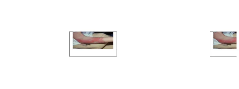 Gambar 8. Gambaran  Nekrolsis  epidermal  toksik  yang  menyerupai  luka  bakar.  Tampak  kemerahan dan terdapat lepuhan.