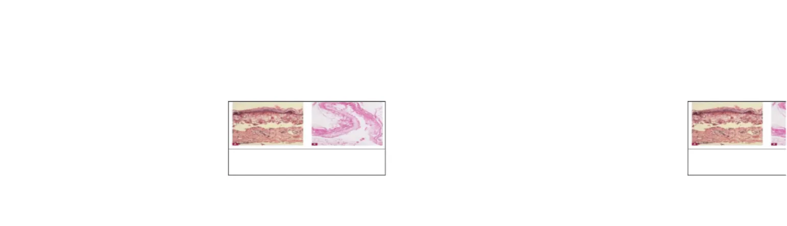Gambar  3: Gambar  histopatologi  nekrolisis  epidermal  toksik.  A:  nekrosis  epidermisdengan  sedikit reaksi dilapisan dermis pada stadium puncak
