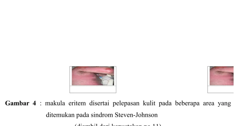 Gambar  4 :  makula  eritem  disertai  pelepasan  kulit  pada  beberapa  area  yang ditemukan pada sindrom Steven-Johnson