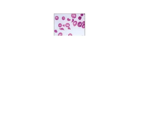 Gambar 1. Apusan darah dari pasien dengan sindrom hemolitik uremik. 6