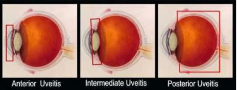 Gambar 2. Klasifikasi Uveitis Berdasarkan Anatomi