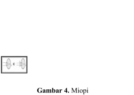 Gambar 4. Miopi
