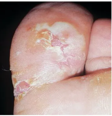 Gambar 6. Tinea pedis tipe bulosa. Vesikel pecah, bula, eritema, dan erosi pada bagian belakang dari ibu jari kaki.