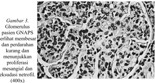 Gambar 3. Glomerulus pasien GNAPS terlihat membesar dan perdarahan kurang dan menunjukkan proliferasi mesangial dan eksudasi netrofil